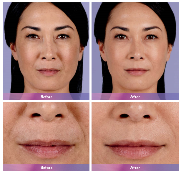 Juvederm Ultra4 Dermal Filler For Lips Enlargement