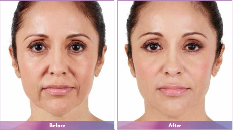 Juvederm Ultra4 Dermal Filler For Lips Enlargement