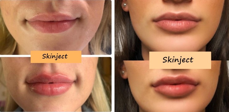 2 X 1 ML JUVEDERM ULTRA 3 Lips Augmentation Cross Linked Dermal Filler