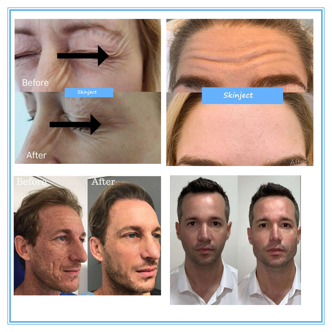 2 X 1 ML JUVEDERM ULTRA 3 Lips Augmentation Cross Linked Dermal Filler