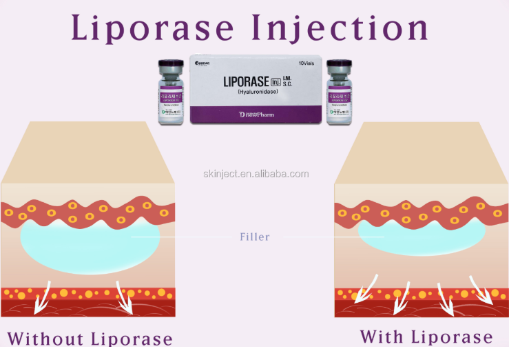 Liporase Injection Dissolves Hyaluronic Acid Hyalutonidase