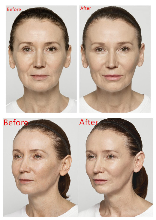 Restylane Lyft Lidocaine Remove Facial Wrinkles Injection Hyaluronic Acid Dermal Filler