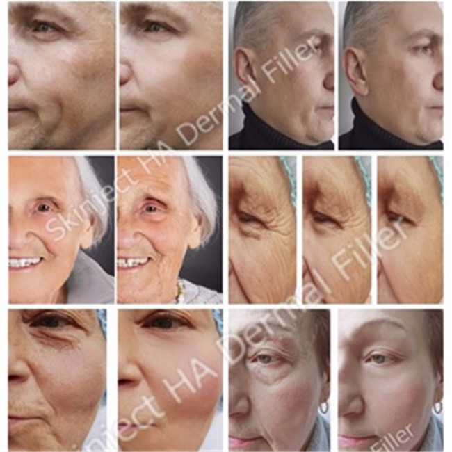 Juvederm Ultra 4 Filler HA Filler Hyaluronic Acid Dermal Filler Cross Linked Dermal Filler Injection For Lips/Face