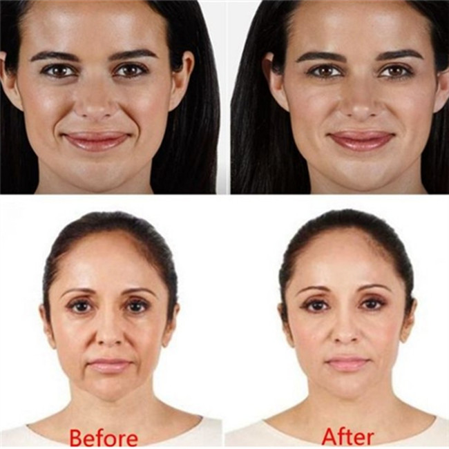 Juvederm Ultra 4 Filler HA Filler Hyaluronic Acid Dermal Filler Cross Linked Dermal Filler Injection For Lips/Face