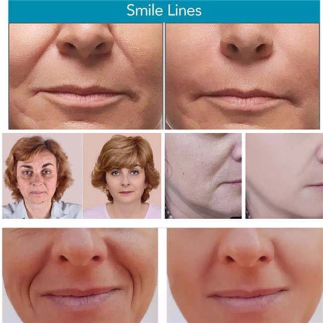 Juvederm Ultra 4 Filler HA Filler Hyaluronic Acid Dermal Filler Cross Linked Dermal Filler Injection For Lips/Face