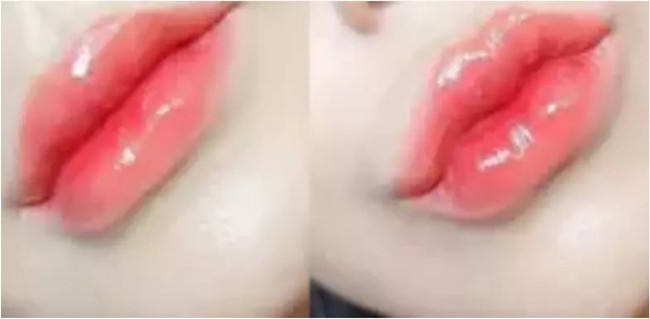 Juvederm Ultra 4 Filler HA Filler Hyaluronic Acid Dermal Filler Cross Linked Dermal Filler Injection For Lips/Face