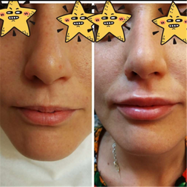 Juvederm Ultra 4 Filler HA Filler Hyaluronic Acid Dermal Filler Cross Linked Dermal Filler Injection For Lips/Face