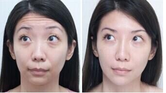 Well-known Restylane Facial Filling Hyaluronic Acid Dermal Filler