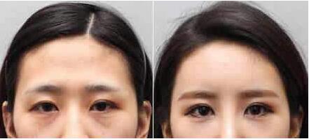 Well-known Restylane Facial Filling Hyaluronic Acid Dermal Filler