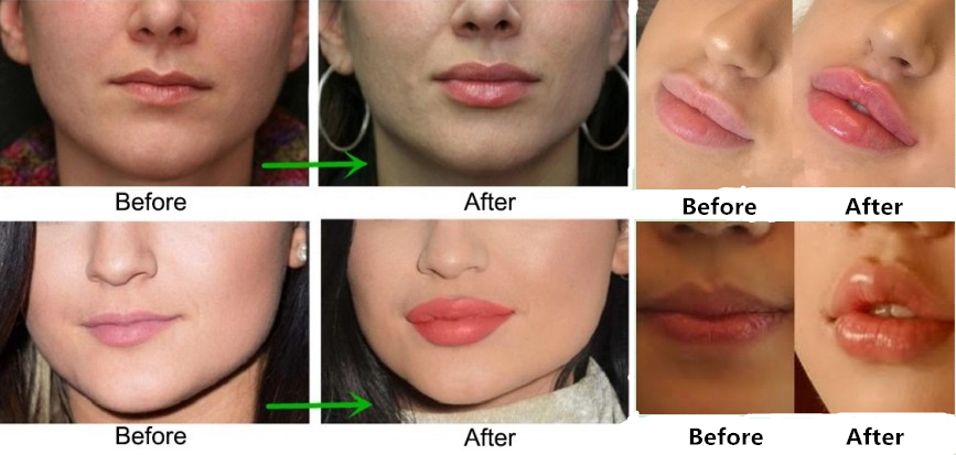 Korea 1.1ml Revolax Deep Cross Linked Hyaluronic Acid Dermal Filler Injection Filler For Lip And Face