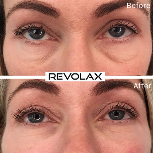 Korea 1.1ml Revolax Deep Cross Linked Hyaluronic Acid Dermal Filler Injection Filler For Lip And Face