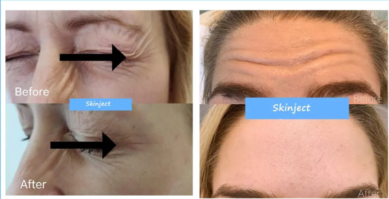 Korea 1.1ml Revolax Deep Cross Linked Hyaluronic Acid Dermal Filler Injection Filler For Lip And Face