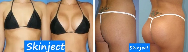 10 Ml Skinject Sub-Skin Penis Enlargement HA Cross Linked Dermal Filler Boob And Buttocks Injection