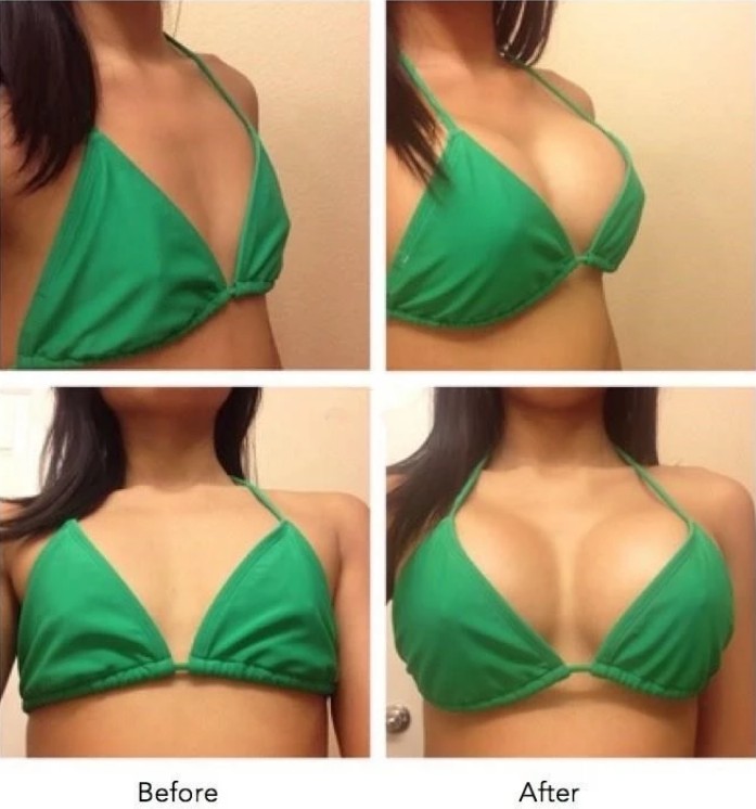 10 Ml Skinject Sub-Skin Penis Enlargement HA Cross Linked Dermal Filler Boob And Buttocks Injection