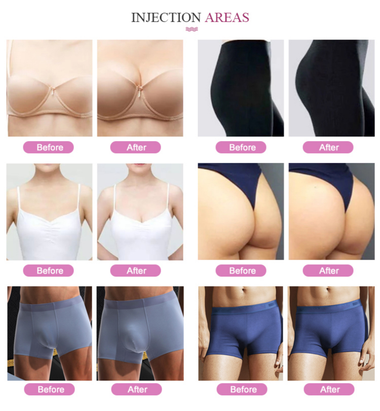Skinject 20ml Subskin Penis Enlargement Dermal Filler Breast And Buttock Augmentation Injection Hyaluronic Acid Dermal Filler