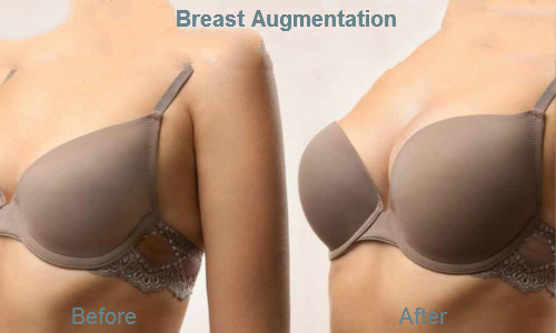 Skinject 20ml Subskin Penis Enlargement Dermal Filler Breast And Buttock Augmentation Injection Hyaluronic Acid Dermal Filler