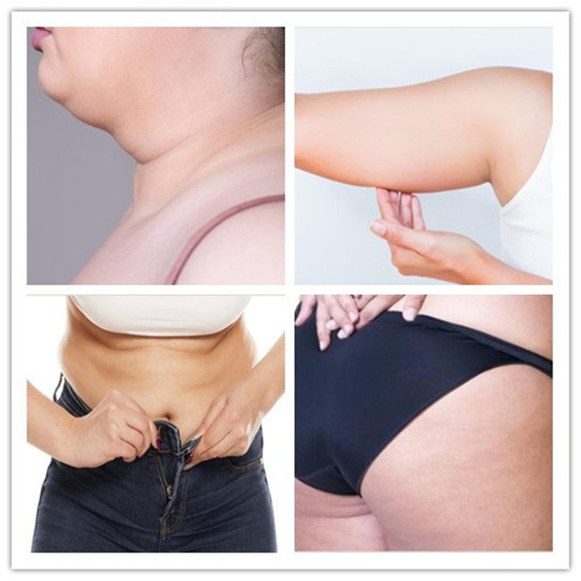 Hyamely Fat Dissolving Weight Loss Solution Dermal Filler