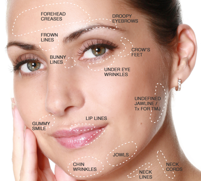 Injection Hyamely Botulinum Toxin Botox Wrinkle Removal Face Lift Cosmetics Products