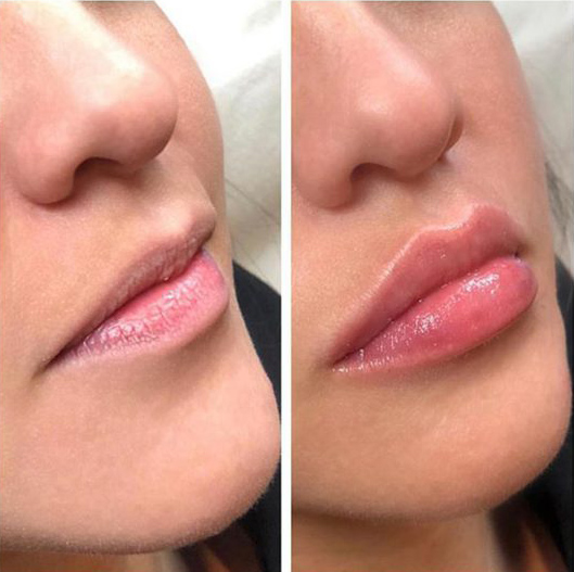 Original Korea Revolax DEEP 1.1 ML With Lidocaine Injectable Dermal Filler