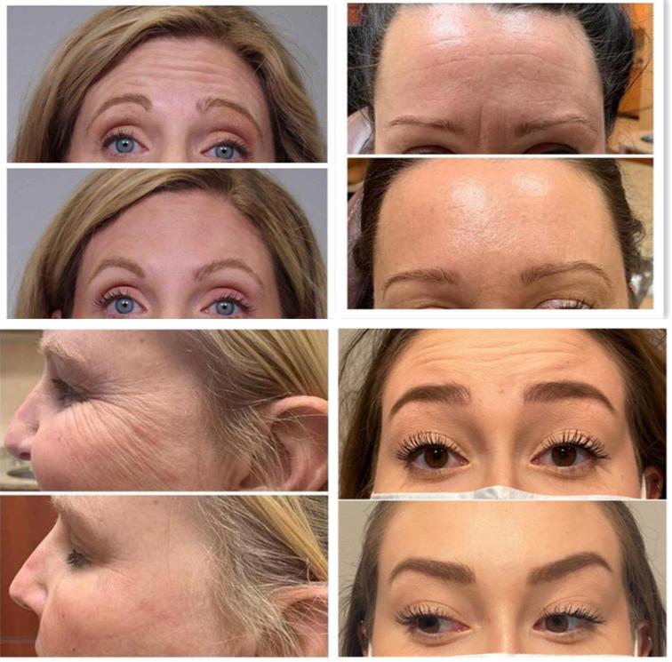 Injection Hyamely Botulinum Toxin Botox Wrinkle Removal Face Lift Cosmetics Products