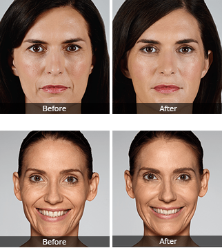 Skinject 5ml Deep Anti Aging Hyaluronic Acid Injection Dermal Filler Facial Wrinkle Removal