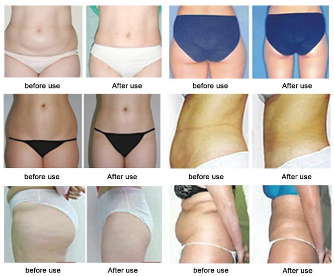 Korea The Red Lipolytic Solution Injectable Lipolysis Fat Dissovling Injection