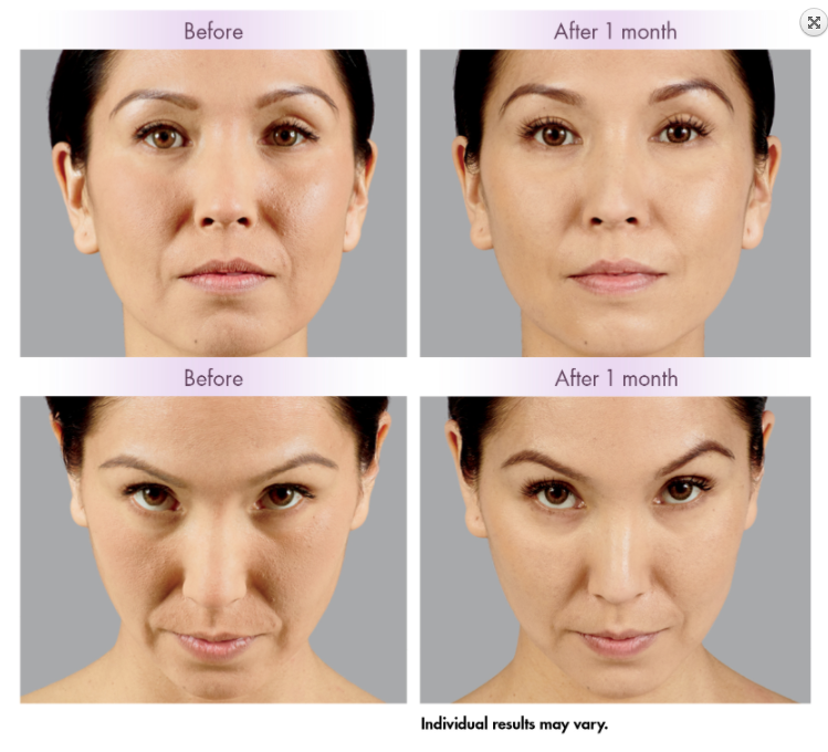 Juvederm Voluma Cross Linked Injection Hyaluronic Acid Dermal Filler Anti Wrinkle