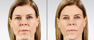 Juvederm Voluma Cross Linked Injection Hyaluronic Acid Dermal Filler Anti Wrinkle