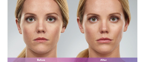 Juvederm Voluma Cross Linked Injection Hyaluronic Acid Dermal Filler Anti Wrinkle