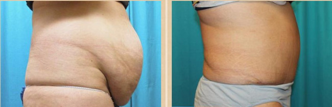 Hyamely Fat Dissolving Weight Loss Solution Dermal Filler