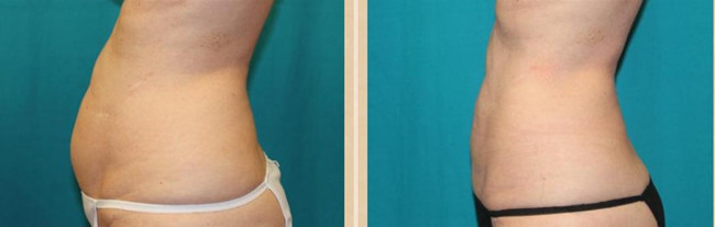 Hyamely Fat Dissolving Weight Loss Solution Dermal Filler