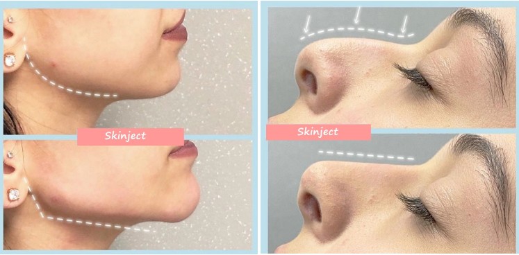 JUVEDERM Voluma with Lidocaine Injectable Dermal Filler Cheek and Chin Augmentation Nose Up