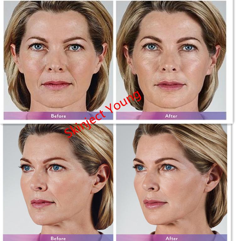 Juvederm Injectable Dermal Filler Hyaluronic Acid Gel Injection Ultra3 Ultra4 Voluma