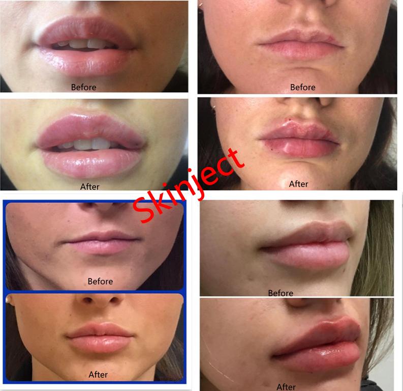 Juvederm Injectable Dermal Filler Hyaluronic Acid Gel Injection Ultra3 Ultra4 Voluma