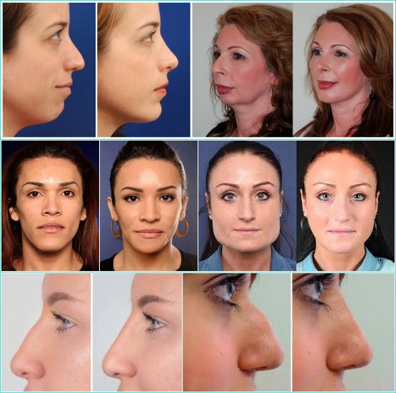 2 ML Skinject Hyaluronic Acid Cross Linked Dermal Filler Cheek and Chin Augmentation