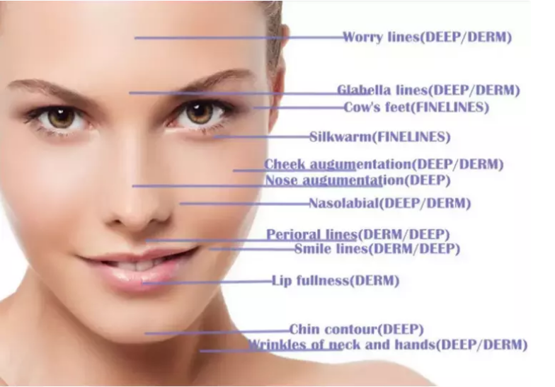 2 ML Skinject Hyaluronic Acid Cross Linked Dermal Filler Cheek and Chin Augmentation